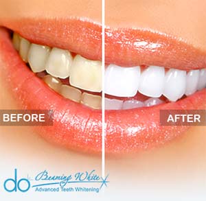 Beaming White Professional Cosmetic Teeth Whitening